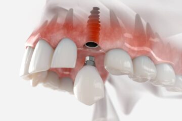 Behandlungsfehler – Entfernung/Neueinsetzung 2 Zahnimplantate – Schmerzensgeld