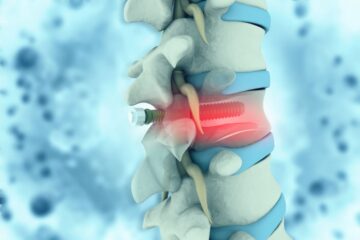 Fehllage von Implantaten – Arzt- und Krankenhaushaftung